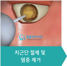 3.치근단 절제 및 염증 제거