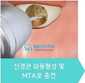 4.신경관 와동형성 및 MTA로 충전