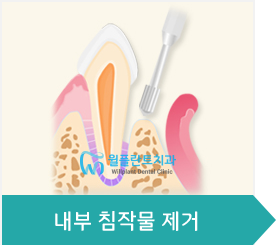 3.내부 침작물 제거