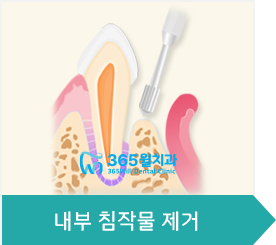 3.내부 침작물 제거