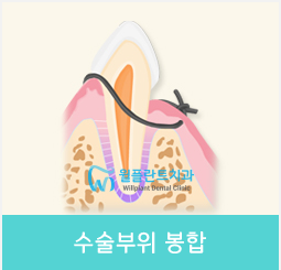 4.수술부위 봉합