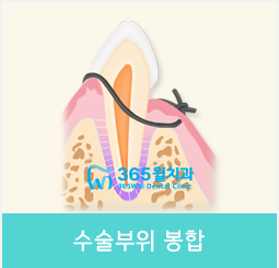 4.수술부위 봉합
